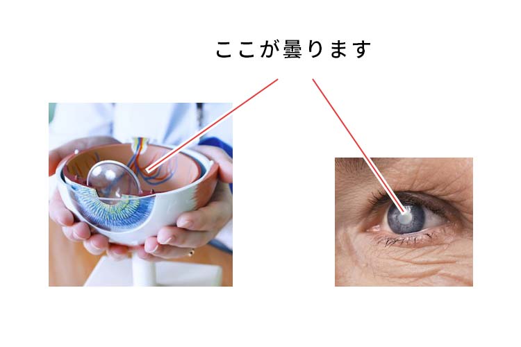白内障ってどんな病気でしょうか