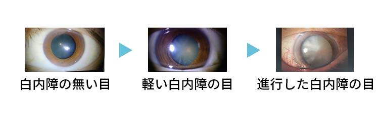 白内障ってどんな病気でしょうか