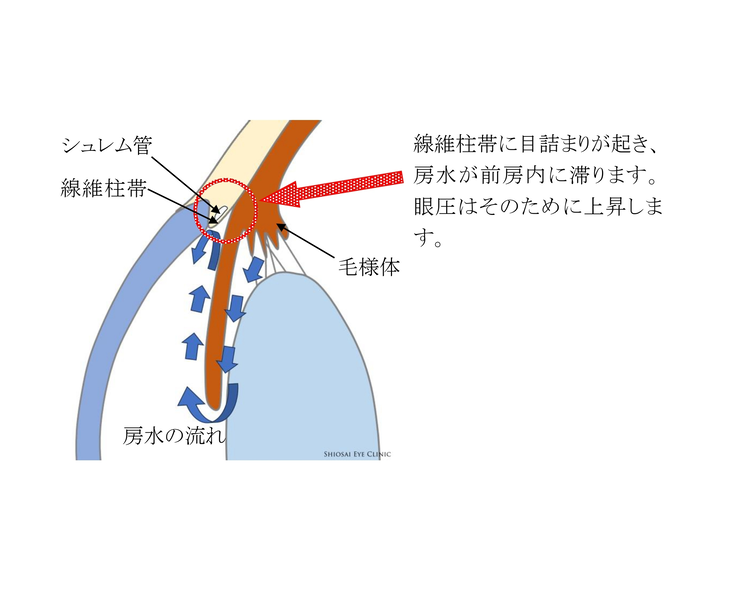 原発開放隅角緑内障(げんぱつかいほうぐうかくりょくないしょう)（正常眼圧緑内障を含みます）