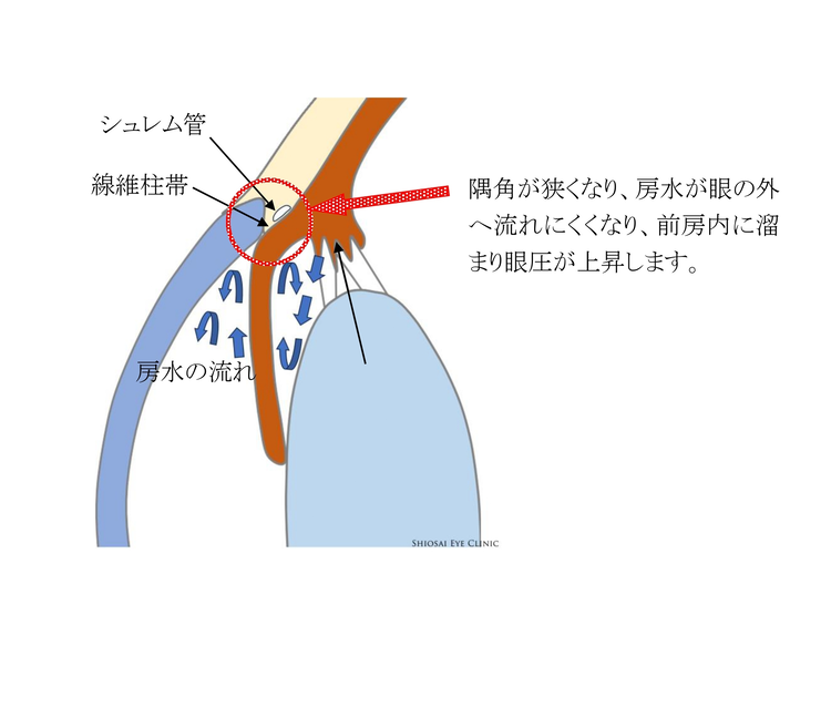 原発閉塞隅角緑内障(げんぱつへいそくぐうかくりょくないしょう)