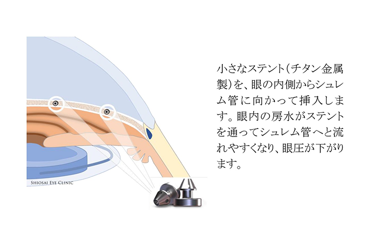 アイステントW