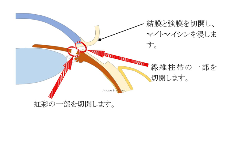 線維柱帯切除術1