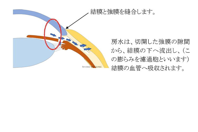 線維柱帯切除術2