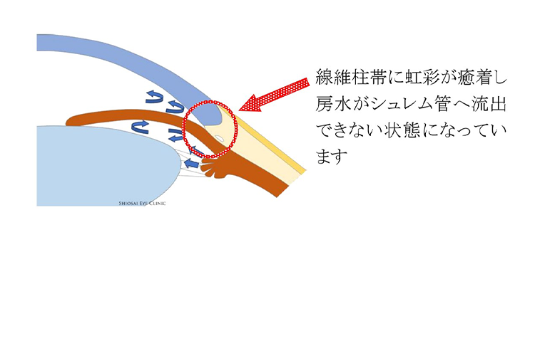 隅角癒着解離術