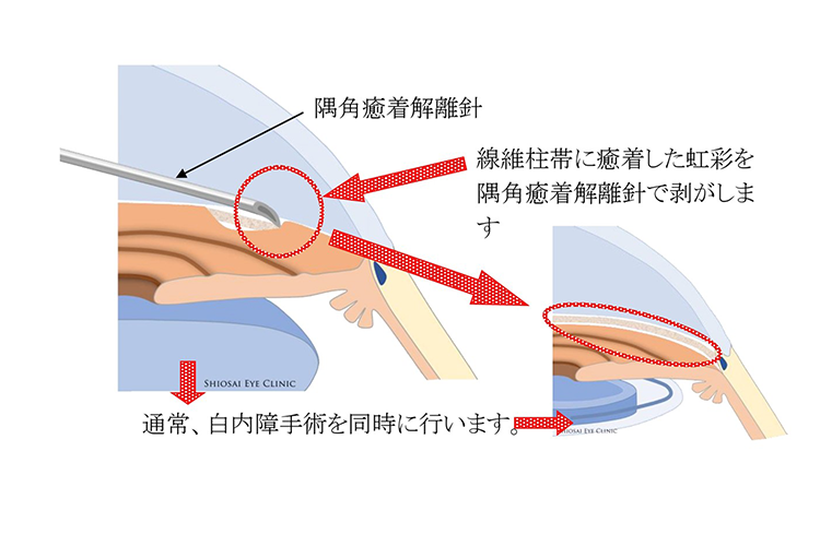 線維柱帯切除術1
