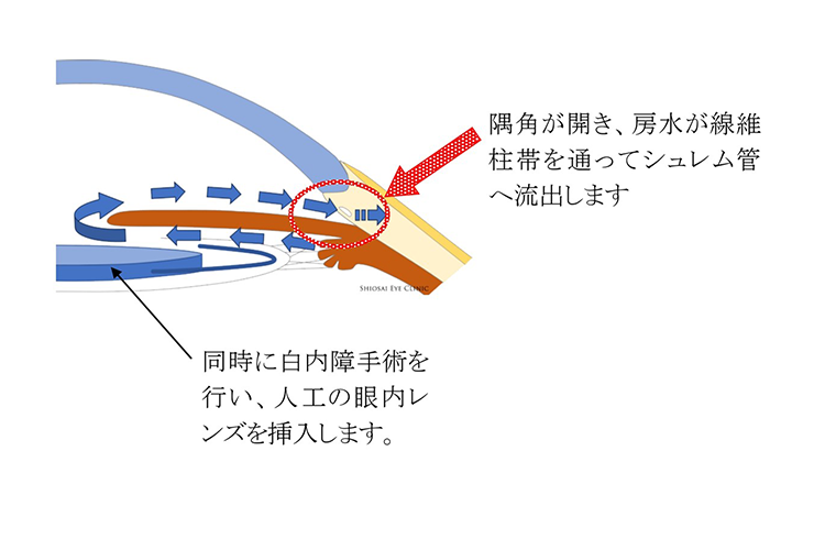 線維柱帯切除術2